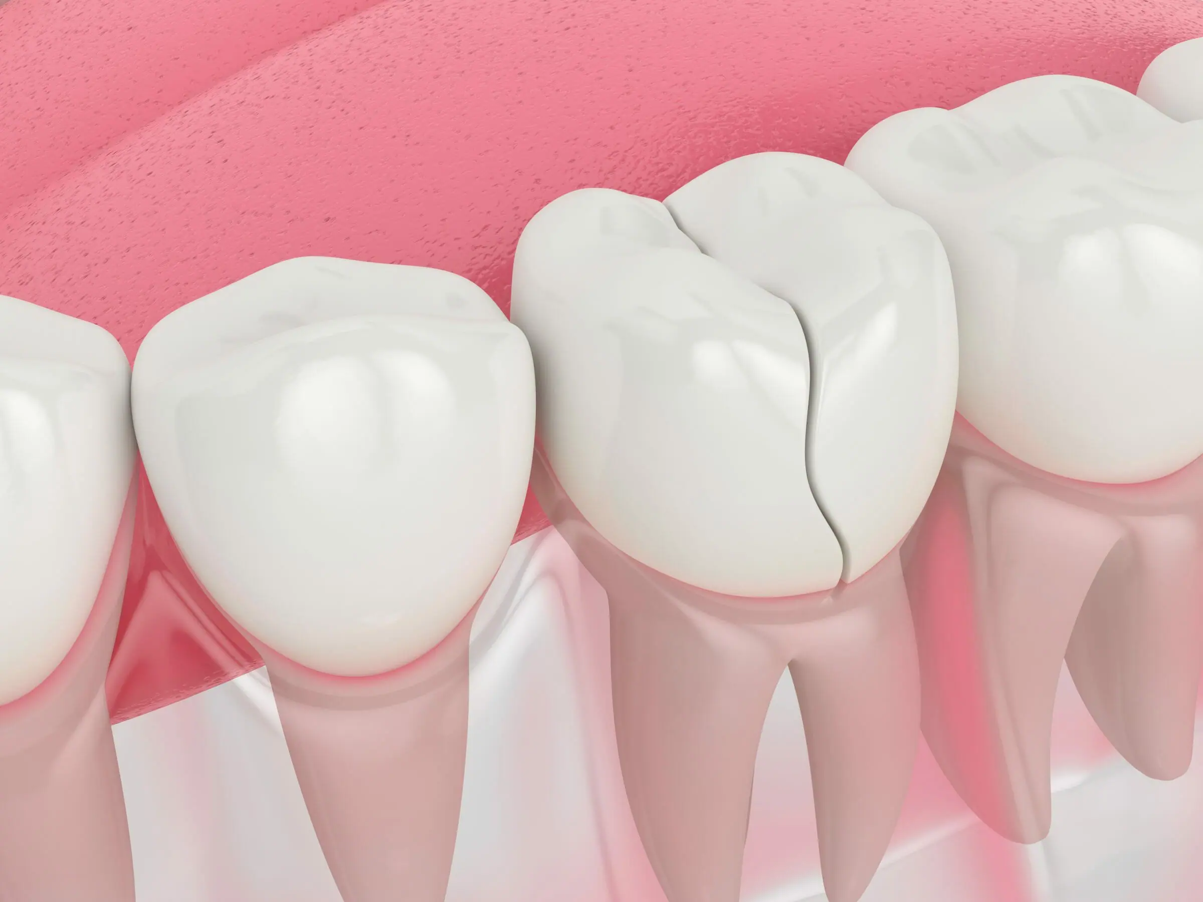 Cracked Tooth Causing Tooth Sensitivity Cracked Tooth Causing Tooth Sensitivity